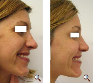 Before/After