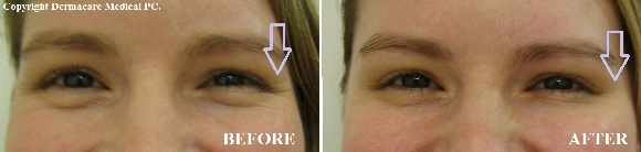 botox crows feet