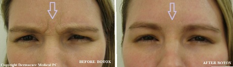 botox glabellar