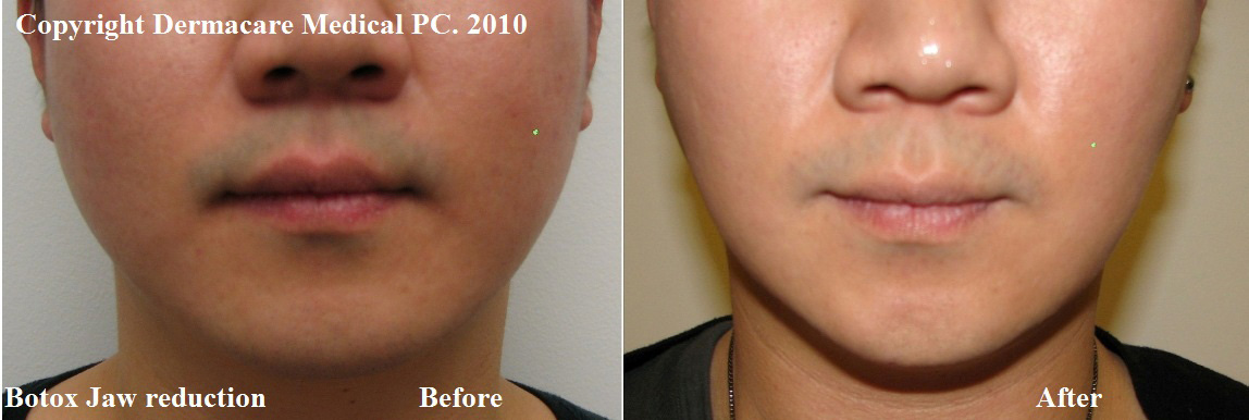 Jaw Reduction / Masseter Botox image from Dermacare Medical