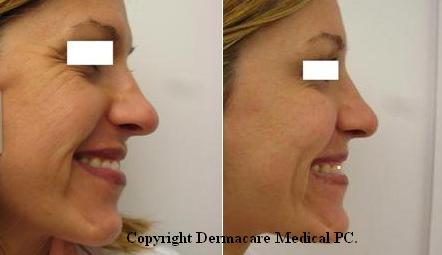 Botox crow's feet before and after comparison