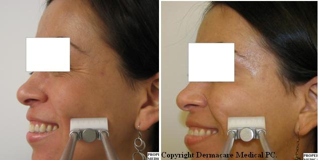 Botox eye-area before and after comparison