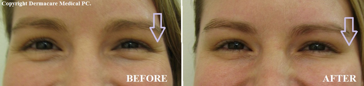 Cosmetic Botox treatment for crow’s feet at Dermacare Medical in NYC