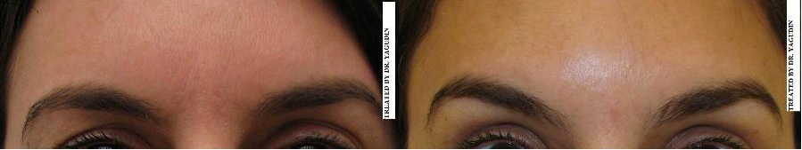 Botox eyebrow lift before and after comparison