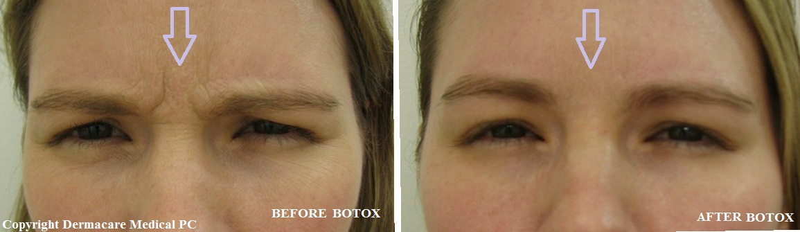 Botox glabellar lines treatment photograph