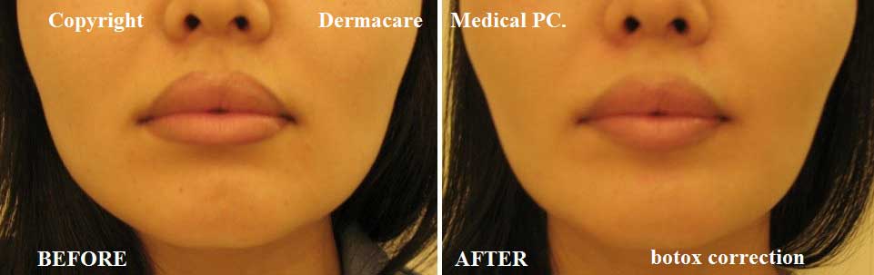 Dermacare Medical Jaw Reduction / Masseter Botox treatment illustration or comparison