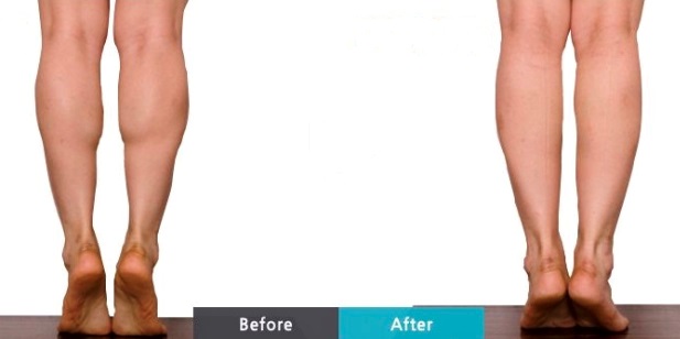 Illustrative calf reduction comparison image