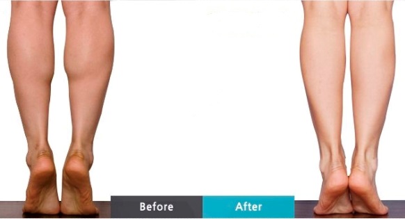 Illustrative calf reduction comparison image