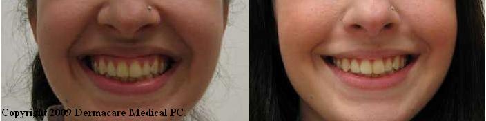 Gummy Smile image from Dermacare Medical