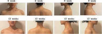 Illustrative trapezius treatment comparison
